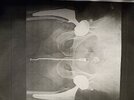 [Bonesmart.org] JamesUK's recovery