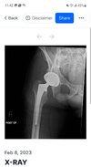 [Bonesmart.org] Heterotopic ossification, not what I expected