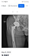 [Bonesmart.org] Heterotopic ossification, not what I expected