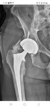 [Bonesmart.org] Heterotopic ossification, not what I expected