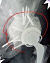 [Bonesmart.org] Complex surgery with revisions, infection, sepsis, and more…
