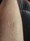 [Bonesmart.org] Right knee revision