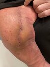[Bonesmart.org] Shoulder scars - post your badges of honour here: NO CHIT-CHAT HERE PLEASE
