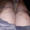 [Bonesmart.org] Knee Scars - Post Your Badges of Honor Here! NO CHIT-CHAT please