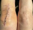 [Bonesmart.org] Knee Scars - Post Your Badges of Honor Here! NO CHIT-CHAT please