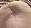 [Bonesmart.org] Hippies scars - post your badges of honor here: NO CHIT-CHAT HERE PLEASE