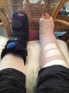 [Bonesmart.org] Ankle surgery 12/21/2023
