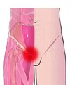[Bonesmart.org] FAI Surgery Round Two—All Done!
