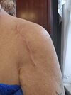 [Bonesmart.org] Shoulder scars - post your badges of honour here: NO CHIT-CHAT HERE PLEASE