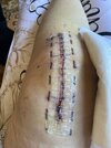 [Bonesmart.org] Knee Scars - Post Your Badges of Honor Here! NO CHIT-CHAT please