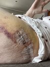 [Bonesmart.org] Hippies scars - post your badges of honor here: NO CHIT-CHAT HERE PLEASE