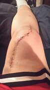 [Bonesmart.org] Knee Scars - Post Your Badges of Honor Here! NO CHIT-CHAT please