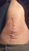 [Bonesmart.org] Knee Scars - Post Your Badges of Honor Here! NO CHIT-CHAT please