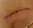 [Bonesmart.org] Hippies scars - post your badges of honor here: NO CHIT-CHAT HERE PLEASE