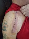 [Bonesmart.org] Shoulder scars - post your badges of honour here: NO CHIT-CHAT HERE PLEASE