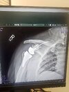 [Bonesmart.org] Shoulder scars - post your badges of honour here: NO CHIT-CHAT HERE PLEASE
