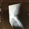 [Bonesmart.org] Shoulder scars - post your badges of honour here: NO CHIT-CHAT HERE PLEASE