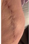 [Bonesmart.org] Hippies scars - post your badges of honor here: NO CHIT-CHAT HERE PLEASE