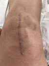 [Bonesmart.org] Patellofemoral PKR with Ehlers Danlos hypermobility