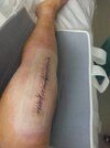 [Bonesmart.org] Knee Scars - Post Your Badges of Honor Here! NO CHIT-CHAT please