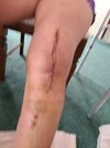 [Bonesmart.org] Knee Scars - Post Your Badges of Honor Here! NO CHIT-CHAT please