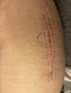 [Bonesmart.org] Hippies scars - post your badges of honor here: NO CHIT-CHAT HERE PLEASE