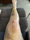 [Bonesmart.org] Knee Scars - Post Your Badges of Honor Here! NO CHIT-CHAT please
