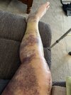 [Bonesmart.org] Knee Scars - Post Your Badges of Honor Here! NO CHIT-CHAT please