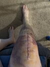 [Bonesmart.org] Knee Scars - Post Your Badges of Honor Here! NO CHIT-CHAT please