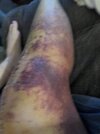[Bonesmart.org] Knee Scars - Post Your Badges of Honor Here! NO CHIT-CHAT please