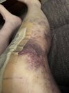 [Bonesmart.org] Knee Scars - Post Your Badges of Honor Here! NO CHIT-CHAT please