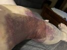 [Bonesmart.org] Knee Scars - Post Your Badges of Honor Here! NO CHIT-CHAT please