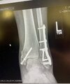 [Bonesmart.org] Ankle surgery 12/21/2023