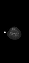 [Bonesmart.org] Patellofemoral PKR with Ehlers Danlos hypermobility