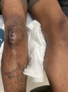 Post op Knee surgery