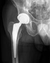 [Bonesmart.org] Quad pain
