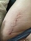 [Bonesmart.org] Hippies scars - post your badges of honor here: NO CHIT-CHAT HERE PLEASE