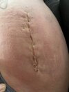 [Bonesmart.org] Hippies scars - post your badges of honor here: NO CHIT-CHAT HERE PLEASE