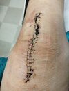 [Bonesmart.org] Dear Diary, Surgery Complete