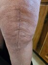 [Bonesmart.org] Knee Scars - Post Your Badges of Honor Here! NO CHIT-CHAT please