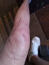 [Bonesmart.org] Knee Scars - Post Your Badges of Honor Here! NO CHIT-CHAT please