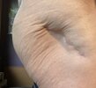 [Bonesmart.org] acetabular cup problems