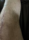 [Bonesmart.org] Jake’s Got a New Knee