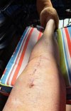 [Bonesmart.org] Knee Scars - Post Your Badges of Honor Here! NO CHIT-CHAT please