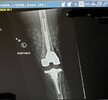 [Bonesmart.org] May 9 2024 Revision TKR - again