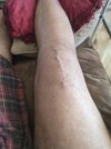 [Bonesmart.org] Knee Scars - Post Your Badges of Honor Here! NO CHIT-CHAT please