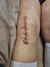 [Bonesmart.org] Knee Scars - Post Your Badges of Honor Here! NO CHIT-CHAT please