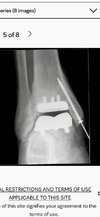 [Bonesmart.org] 13 month TAR Surgeon's Appointment