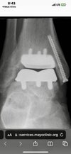 [Bonesmart.org] 13 month TAR Surgeon's Appointment