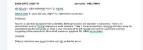 [Bonesmart.org] Heterotopic ossification, not what I expected
